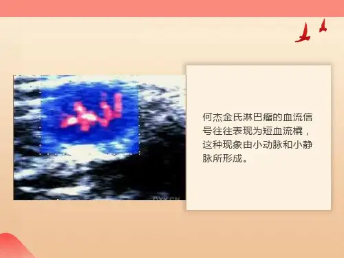 淋巴瘤的超声诊断