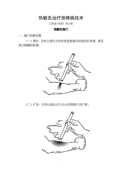 热敏灸治疗颈椎病技术陈日新