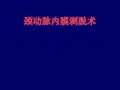 颈动脉内膜剥脱ppt课件