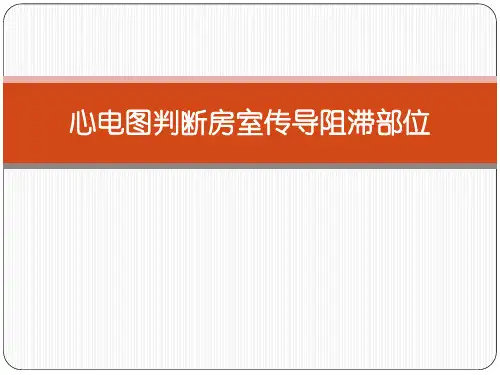 心电图判断房室传导阻滞部位