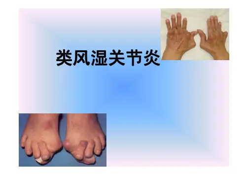 类风湿性关节炎