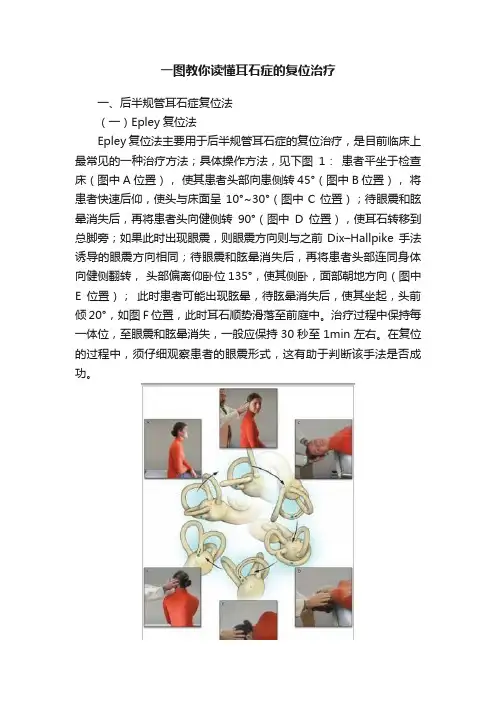 一图教你读懂耳石症的复位治疗