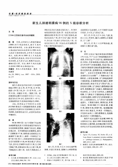 新生儿肺透明膜病98例的X线诊断分析