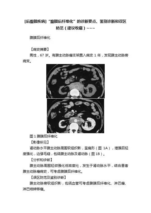 [后腹膜疾病]“腹膜后纤维化”的诊断要点、鉴别诊断和误区防范（建议收藏）~~~