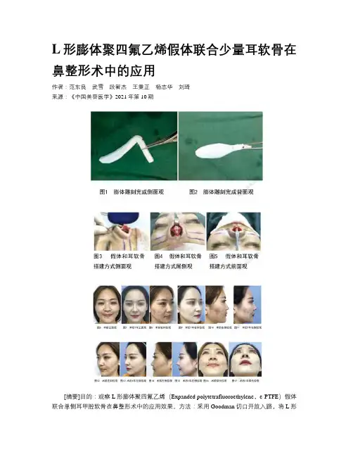 L形膨体聚四氟乙烯假体联合少量耳软骨在鼻整形术中的应用