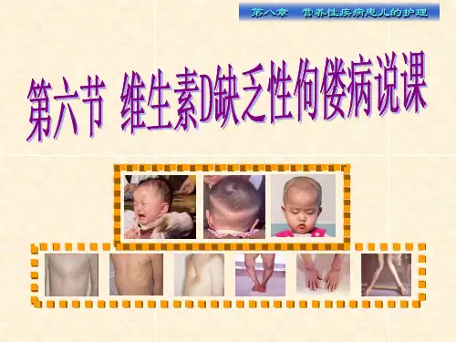 第六节维生素D缺乏性佝偻病说课