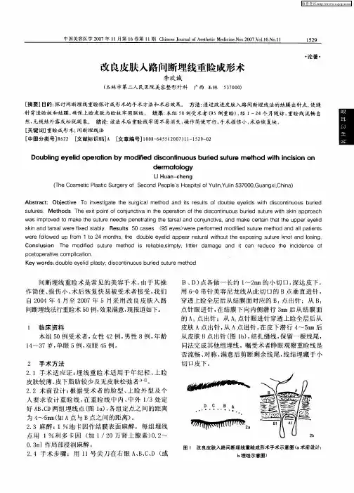 改良皮肤入路间断埋线重睑成形术