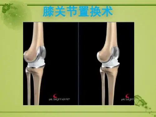 膝关节置换PPT课件