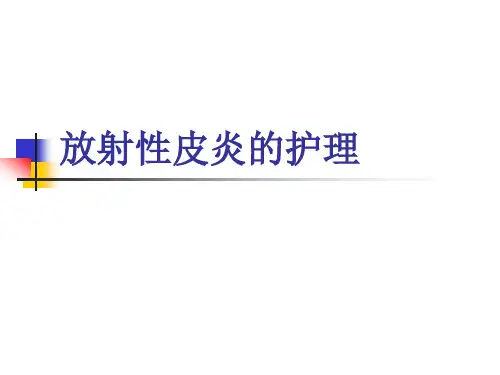 放射性皮炎的护理查房ppt课件