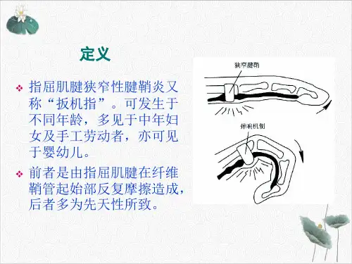 狭窄性腱鞘炎的针刀治疗PPT.