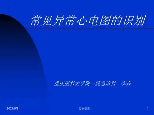 常见异常心电图的识别专业课件PPT