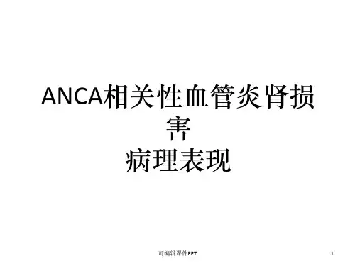 ANCA相关性血管炎肾损害病理表现ppt课件
