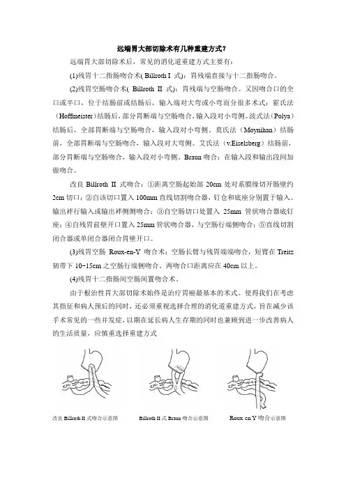 远端胃大切重建方式