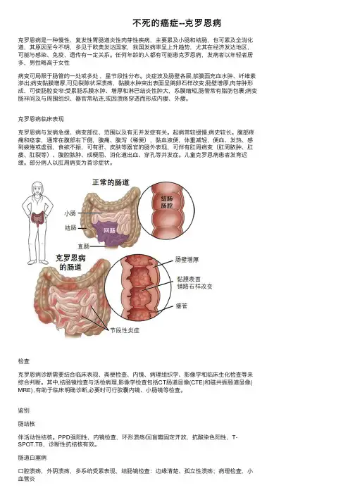 不死的癌症--克罗恩病