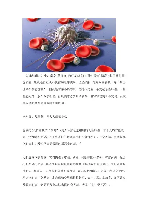五个重点标准判断黑痣是否会癌变