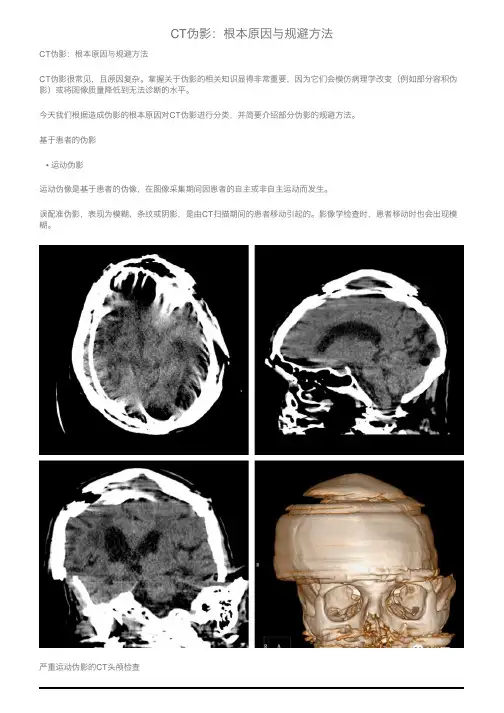 CT伪影：根本原因与规避方法