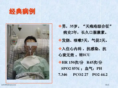 急性呼吸窘迫综合症