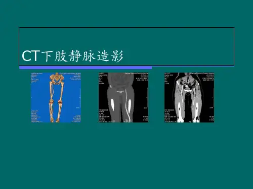 CT下肢静脉造影【放射科】 ppt课件