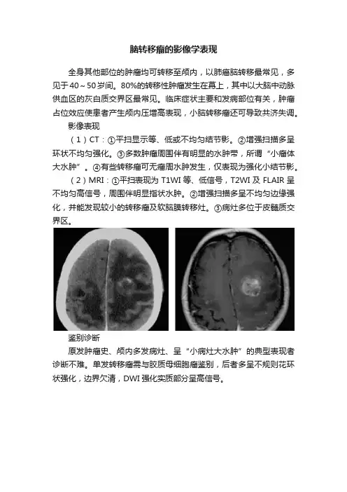 脑转移瘤的影像学表现