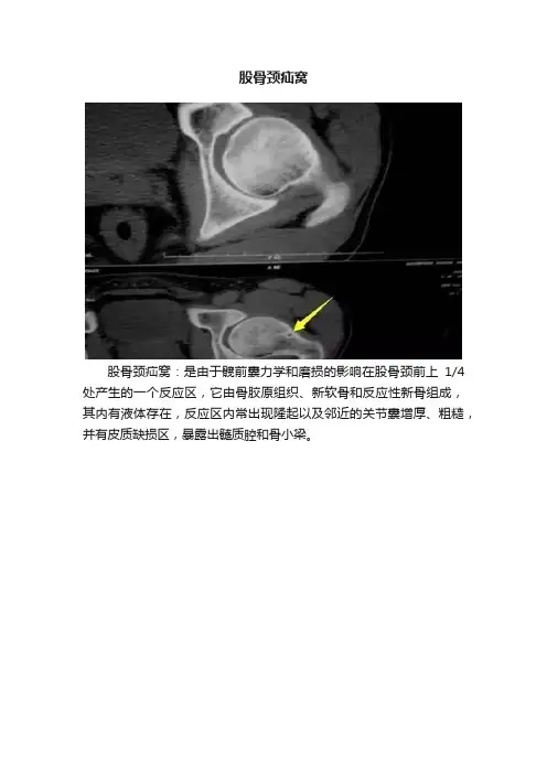 股骨颈疝窝