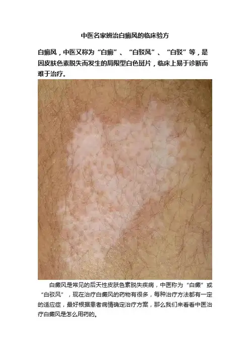 中医名家辨治白癜风的临床验方