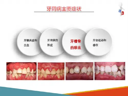 牙周病的主要症状和临床病理 牙槽骨的吸收 牙槽骨的吸收