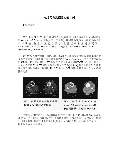 软骨母细胞型骨肉瘤1例