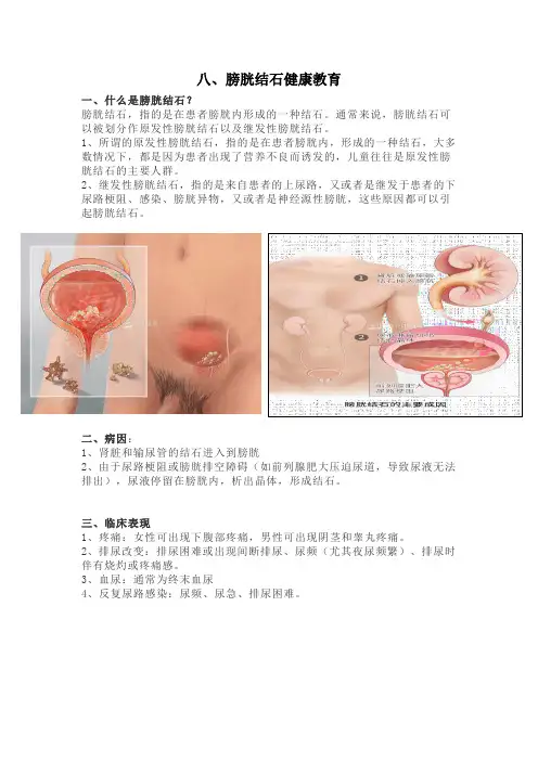 膀胱结石健康宣教
