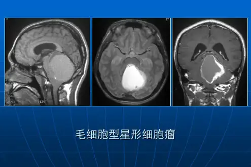 脑瘤疑难病例影像学诊断分析1 ppt课件