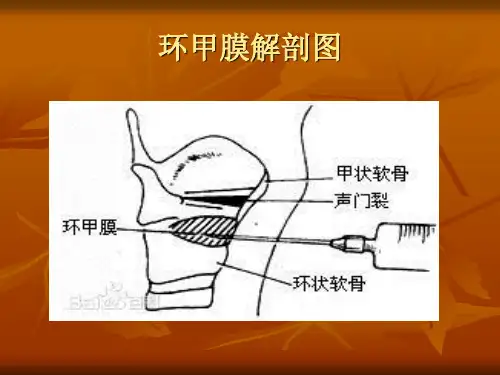 环甲膜穿刺