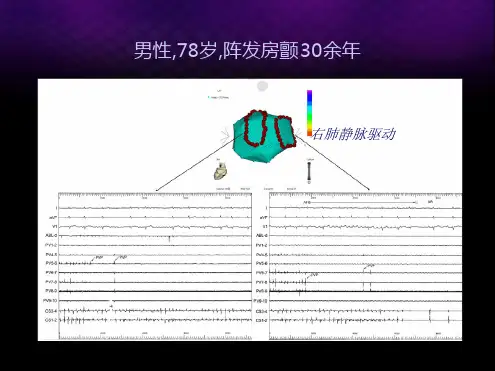 房颤导管消融的适应症参考资料ppt课件