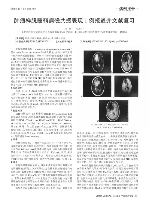 肿瘤样脱髓鞘病磁共振表现1例报道并文献复习
