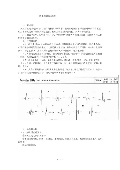 肌电图的临床应用