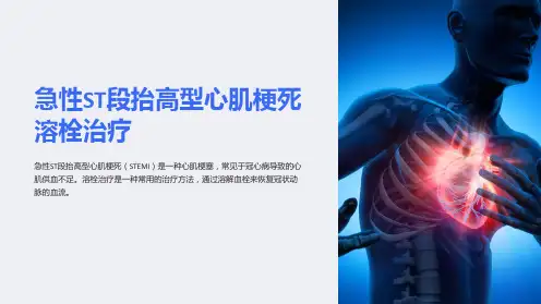 急性ST段抬高型心肌梗死溶栓治疗