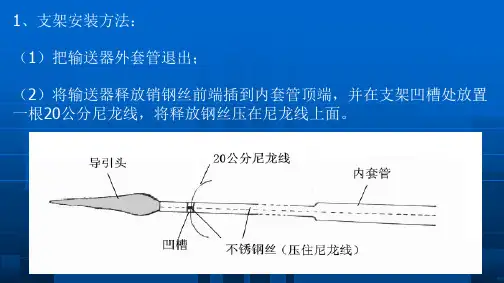 DZAS覆膜食管支架安装及应用