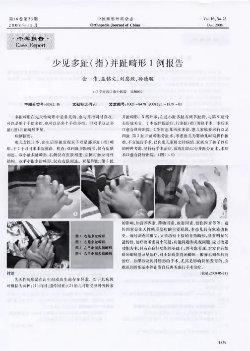少见多趾(指)并趾畸形1例报告