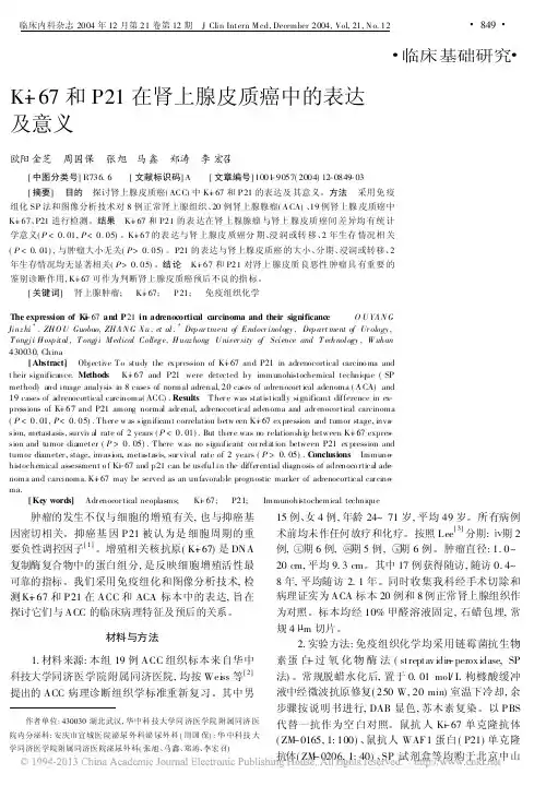 Ki_67和P21在肾上腺皮质癌中的表达及意义
