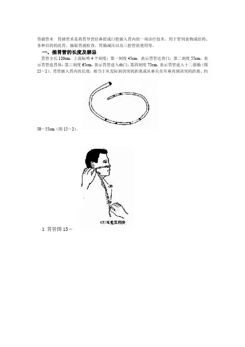 胃插管术