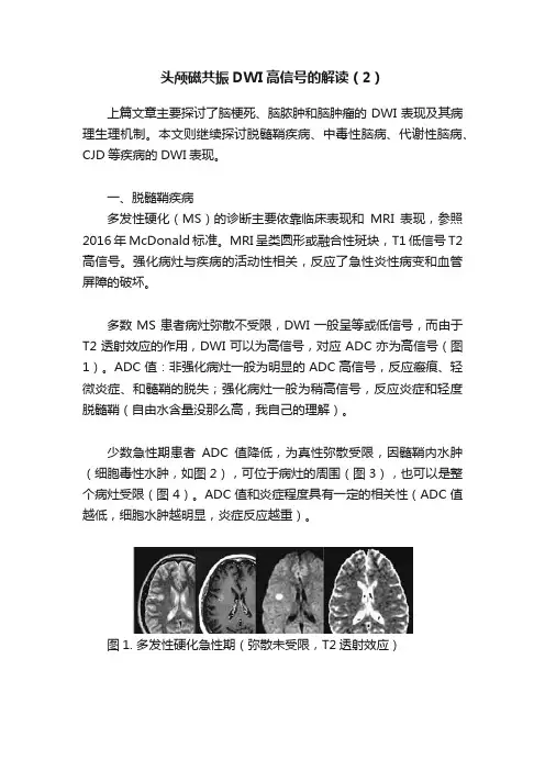 头颅磁共振DWI高信号的解读（2）