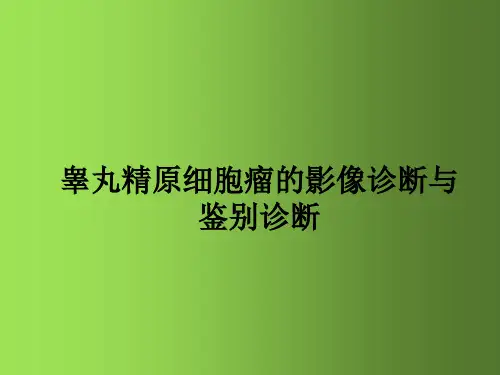 睾丸精原细胞瘤的影像诊断与鉴别诊断