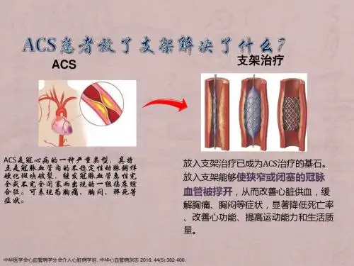 ACS患教ppt课件