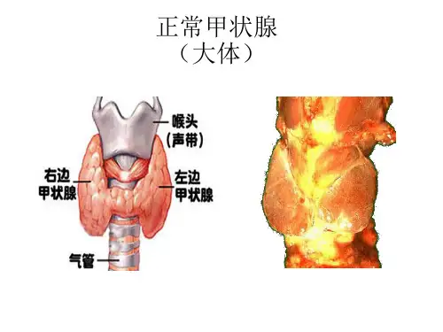 1.1.29甲状腺疾病病理学生理学课件