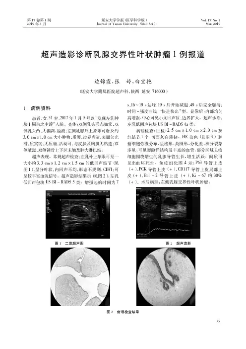 超声造影诊断乳腺交界性叶状肿瘤1例报道