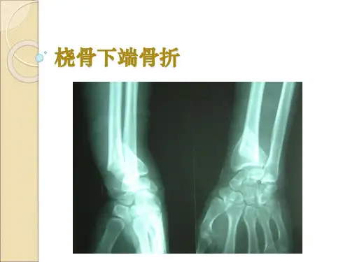 桡骨远端骨折