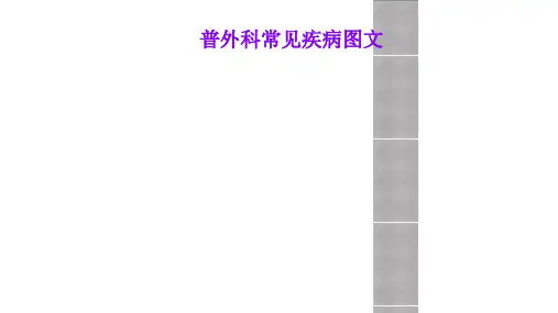 普外科常见疾病图文