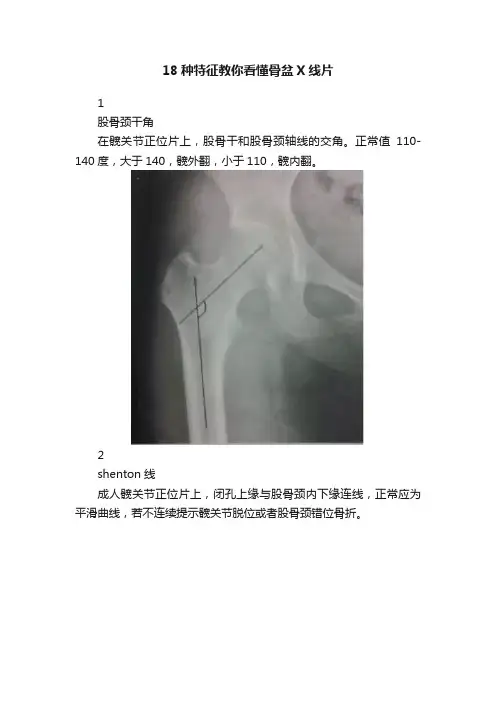 18种特征教你看懂骨盆X线片