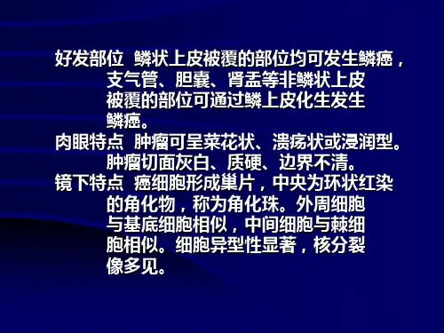 基础医学北大病理学PPT课件恶性上皮性肿瘤