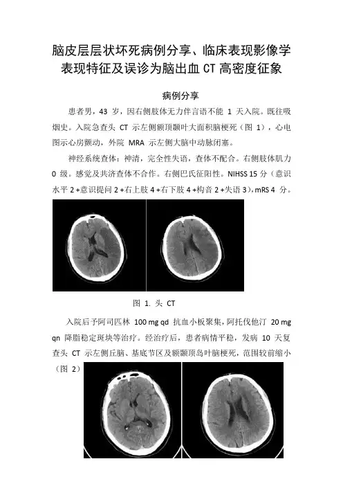 脑皮层层状坏死病例分享、临床表现影像学表现特征及误诊为脑出血CT高密度征象
