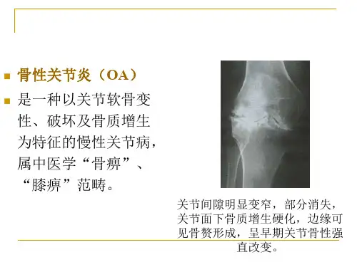 骨性关节炎—中医骨病学