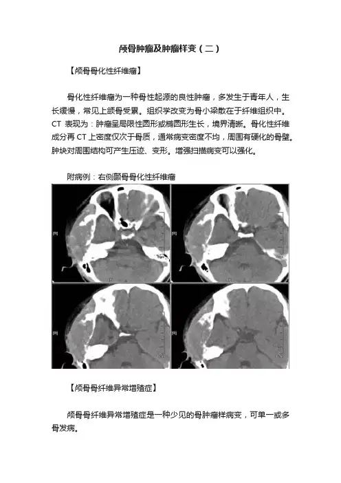 颅骨肿瘤及肿瘤样变（二）